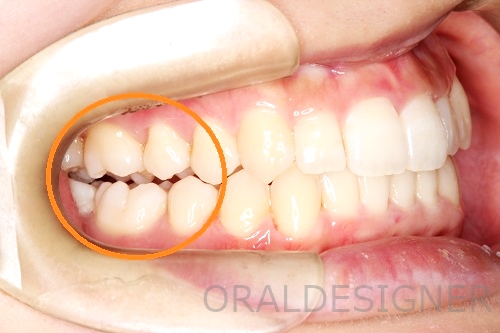 インビザライン　奥歯が咬まない