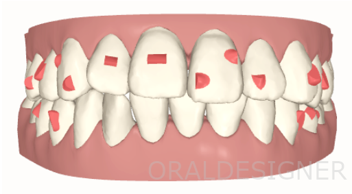 インビザライン　アタッチメント