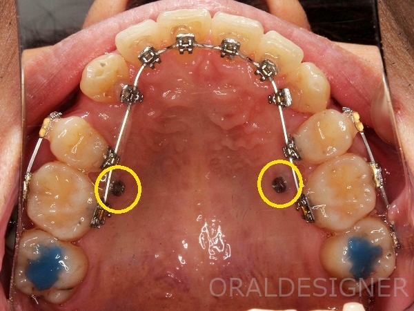 矯正用インプラント　裏側矯正ととても相性が良い