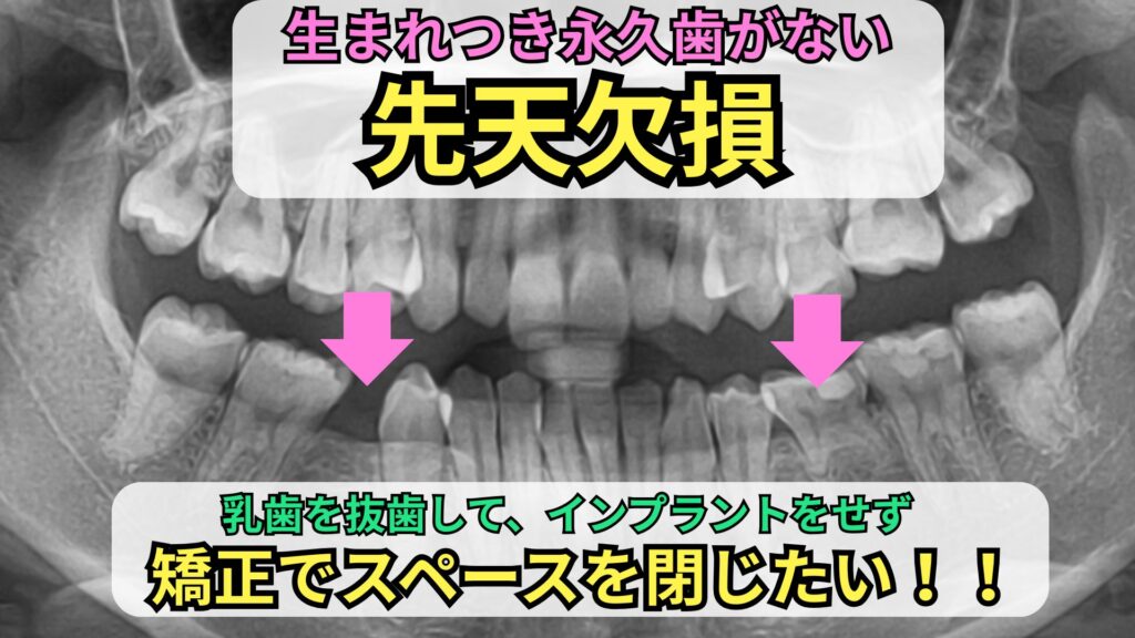 先天欠損（矯正でスペースを閉じる）