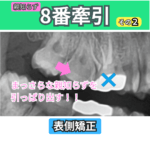 8番（親知らず）の牽引（その２）