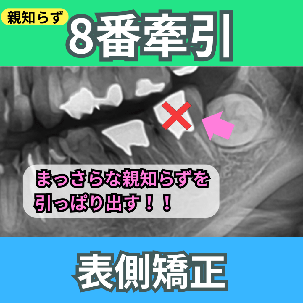 8番（親知らず）の牽引（その１）