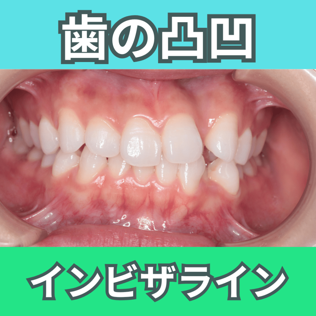 インビザライン（その１・歯の凸凹（叢生））