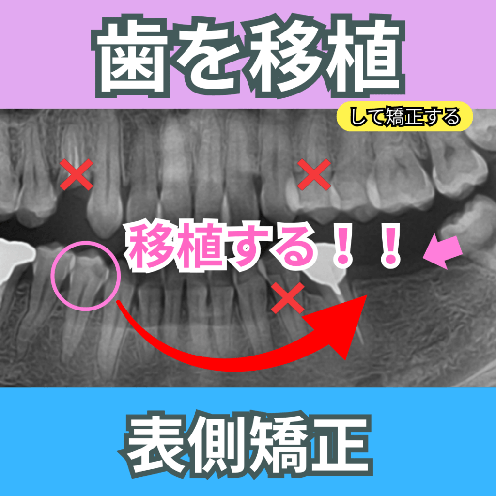 抜いた歯を移植して矯正する