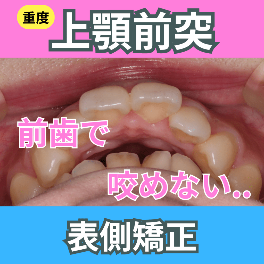 重度上顎前突