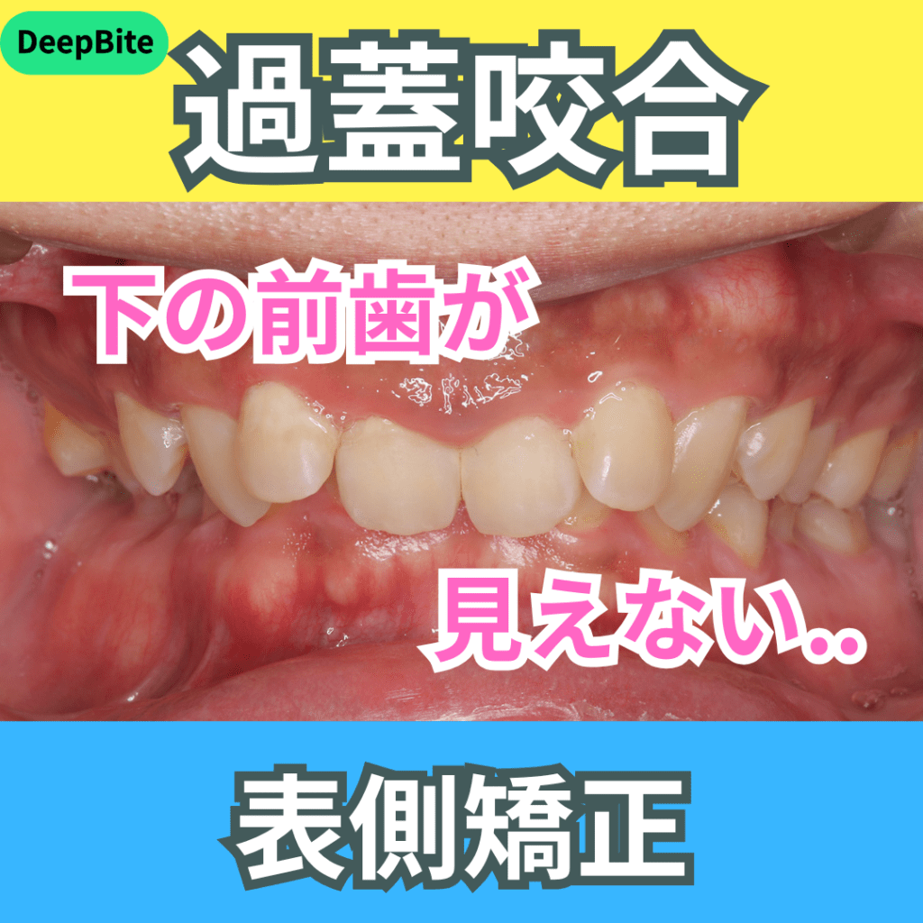 過蓋咬合（DeepBite）