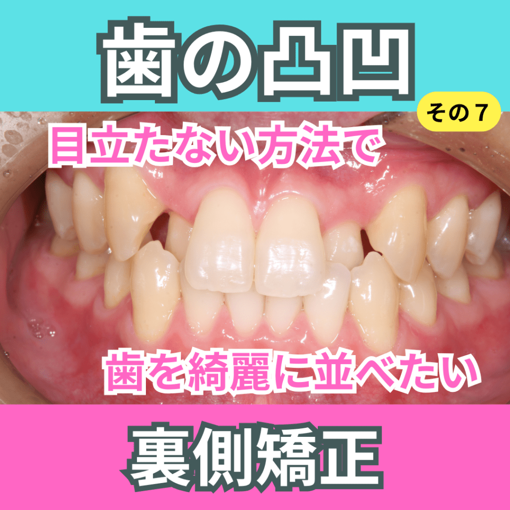 叢生7（上下裏側矯正）