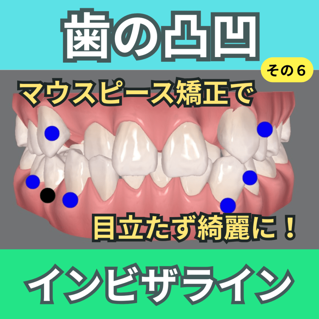 叢生6(歯の凸凹)～インビザライン治療動画～