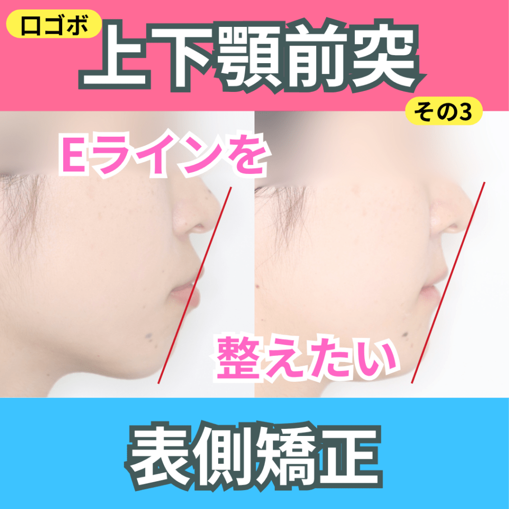 上下顎前突(口ゴボ）（その３）