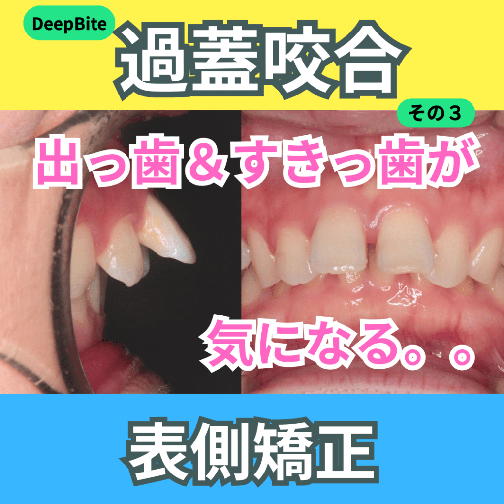 DeepBite（過蓋咬合）（その3）・上顎前突・すきっ歯（正中離開）
