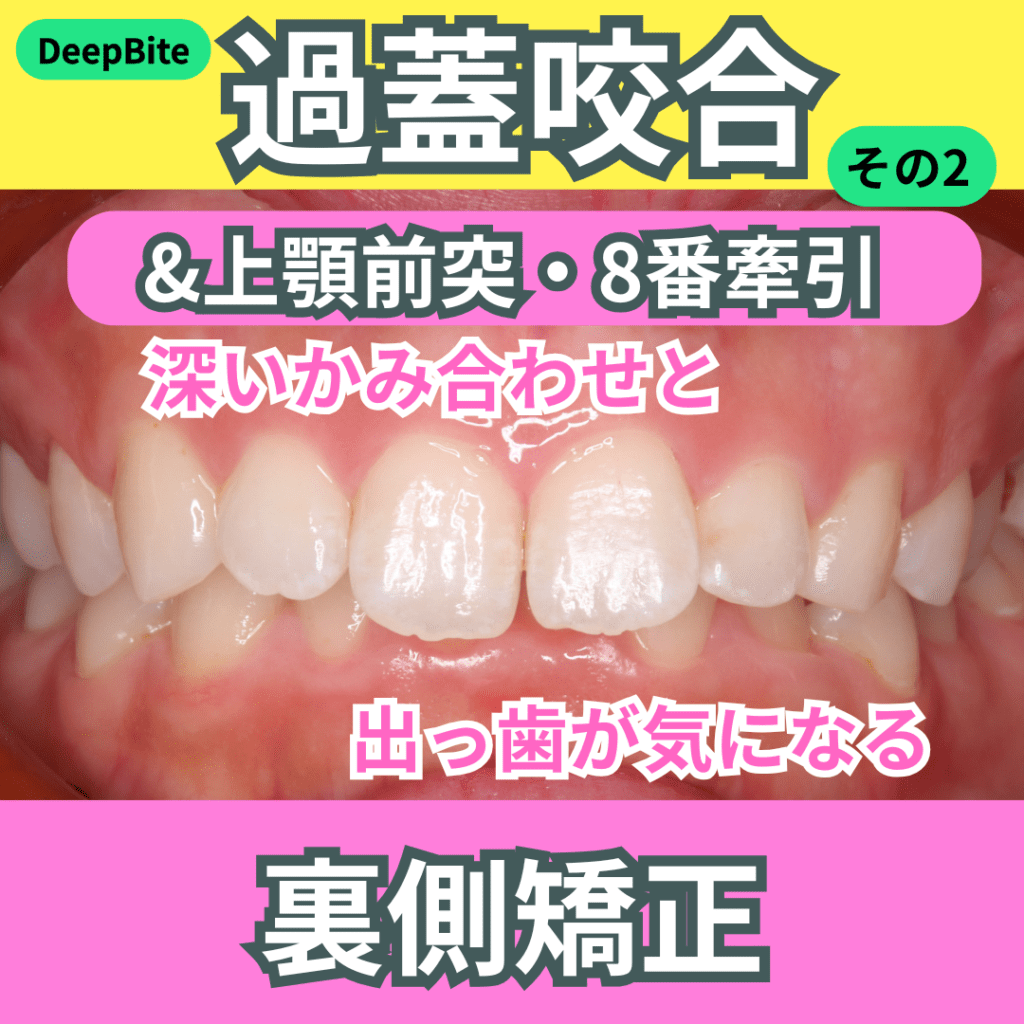 DeepBite（過蓋咬合）（その２）・上顎前突・8番牽引