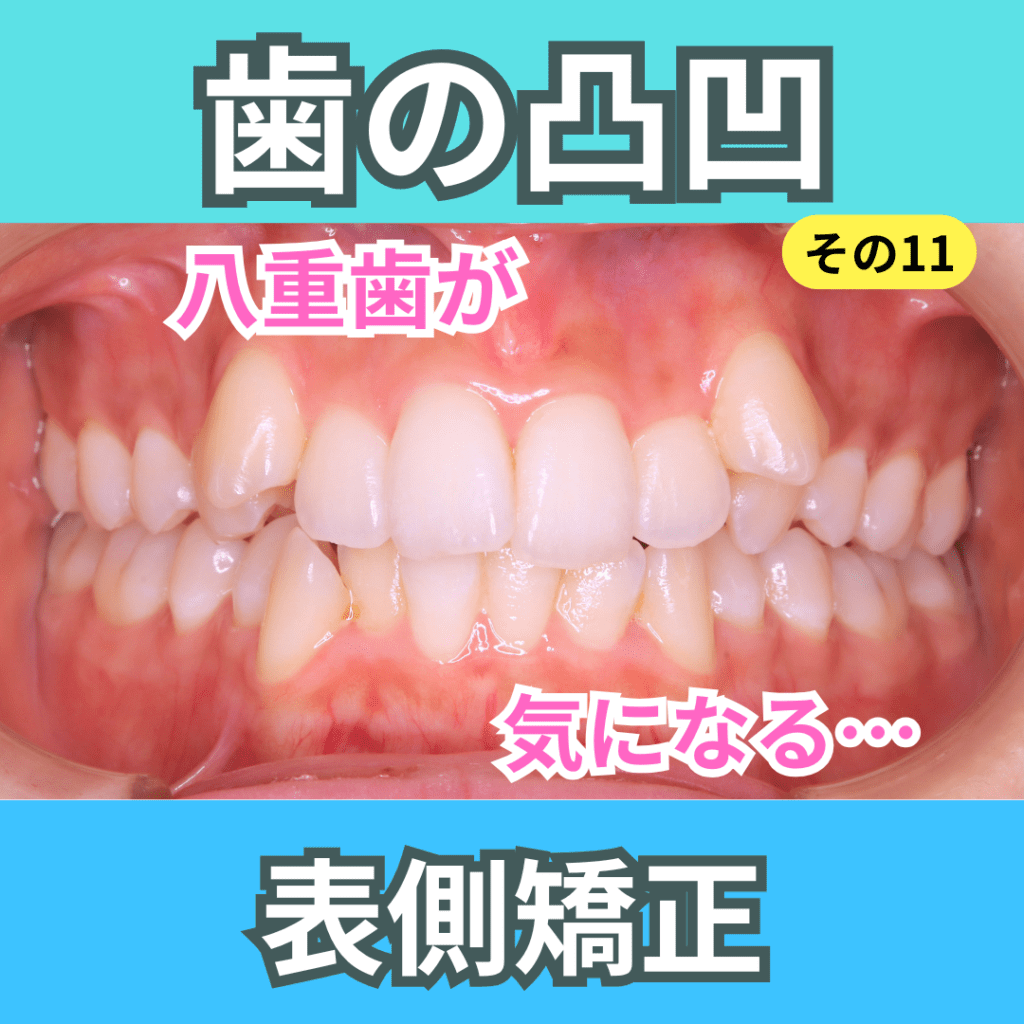 叢生11（表側矯正）
