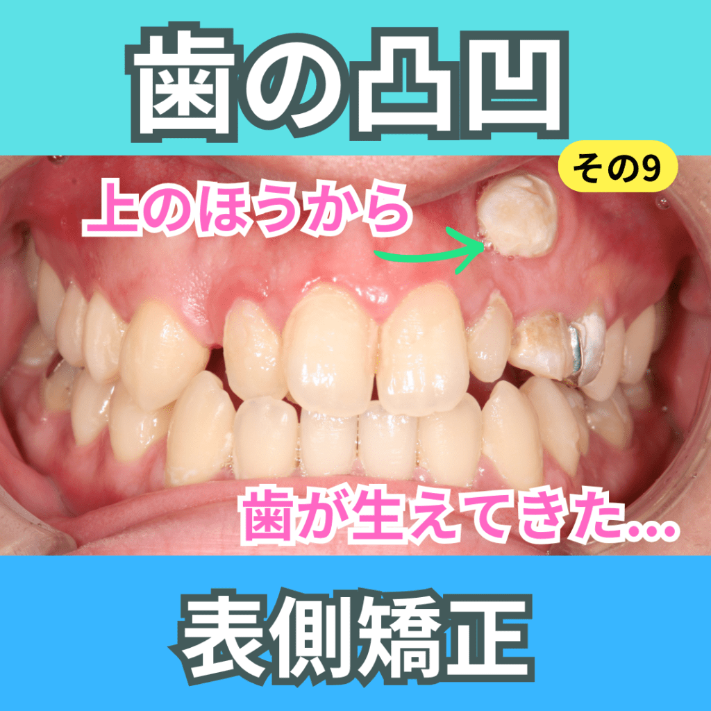 叢生9（表側矯正）