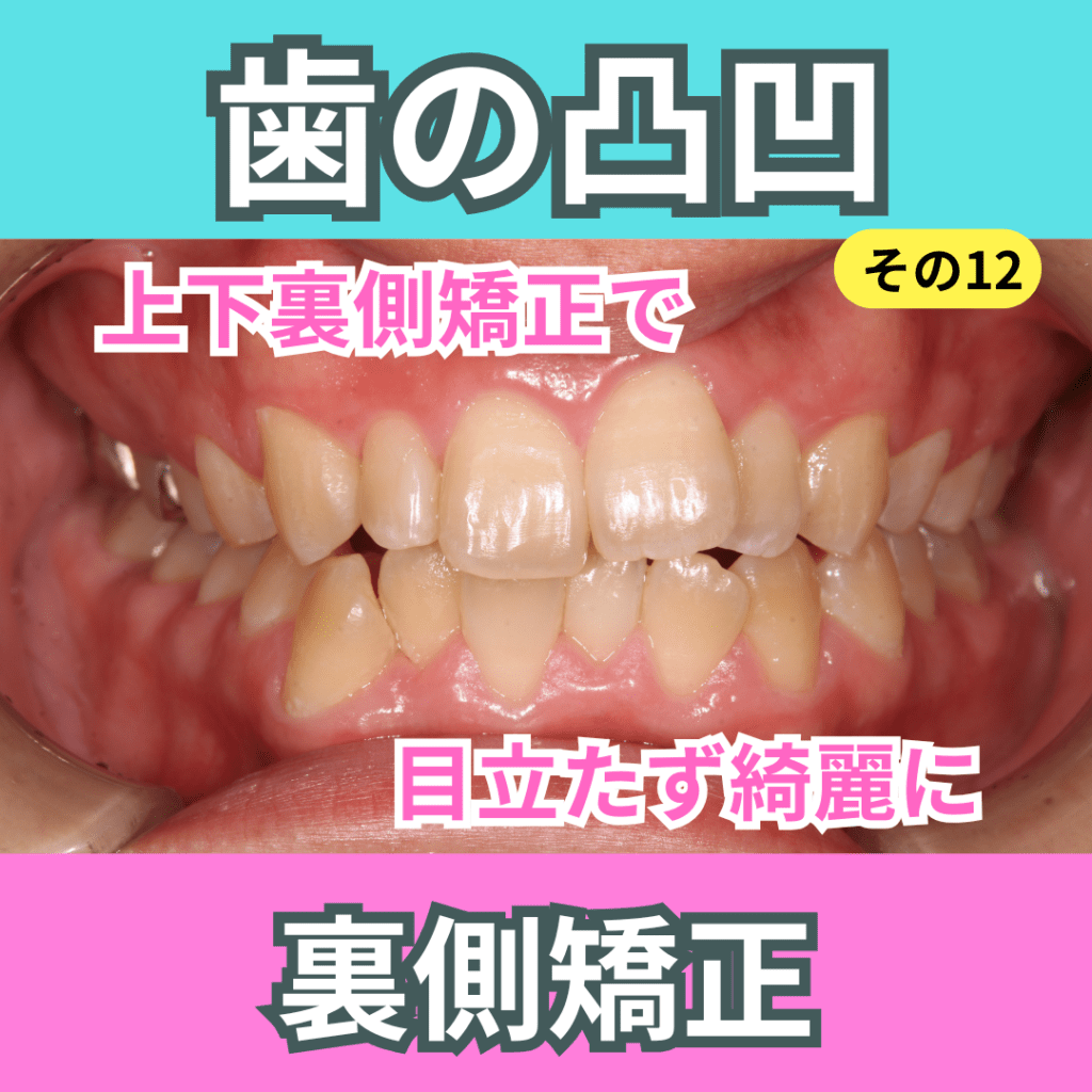 叢生12（上下裏側矯正）