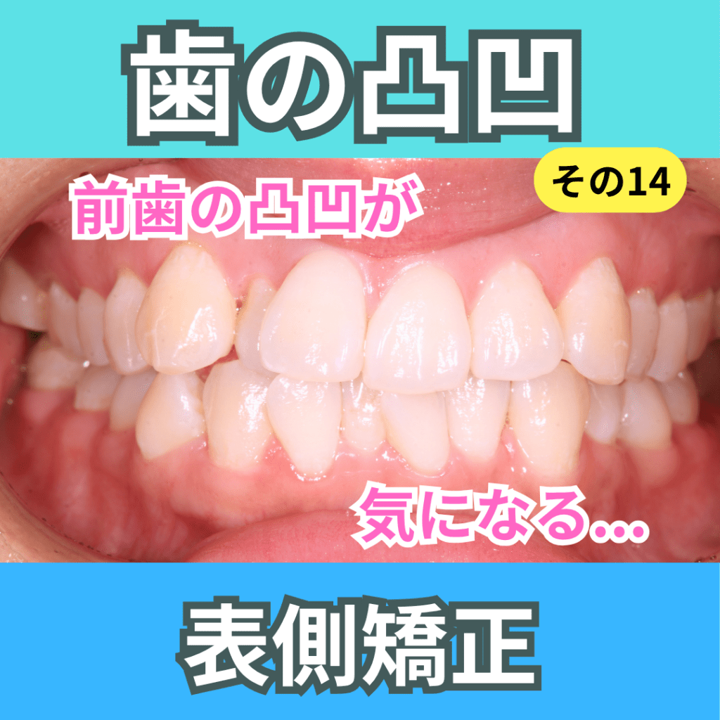 叢生14（表側矯正）