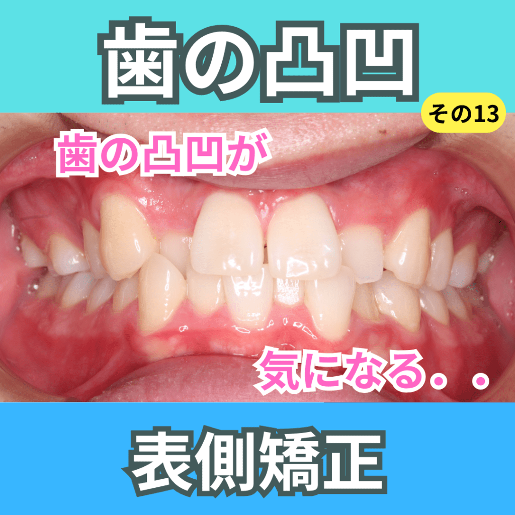 叢生13（表側矯正）