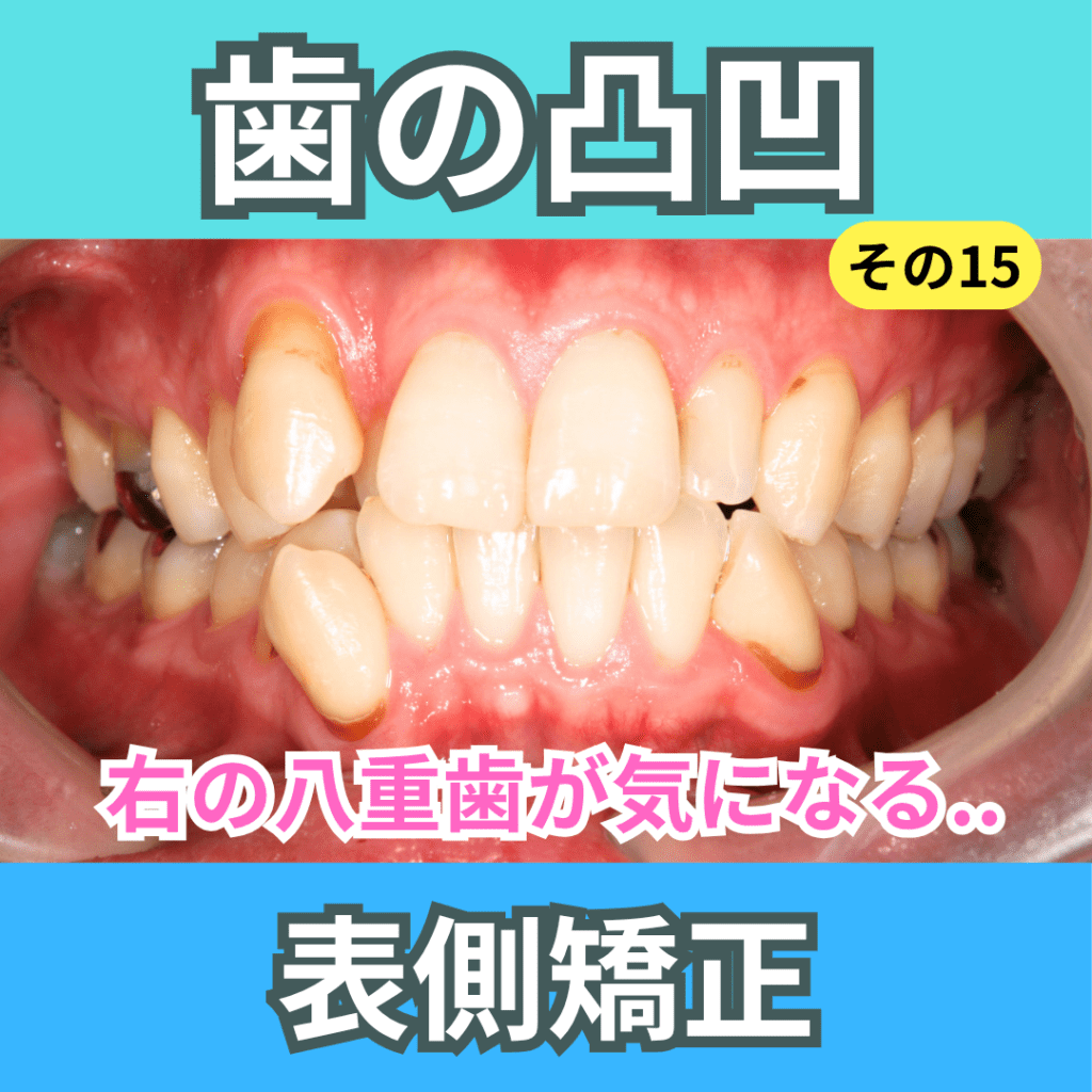 叢生15（表側矯正）
