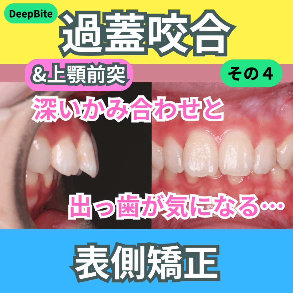 DeepBite（過蓋咬合）（その４）・上顎前突