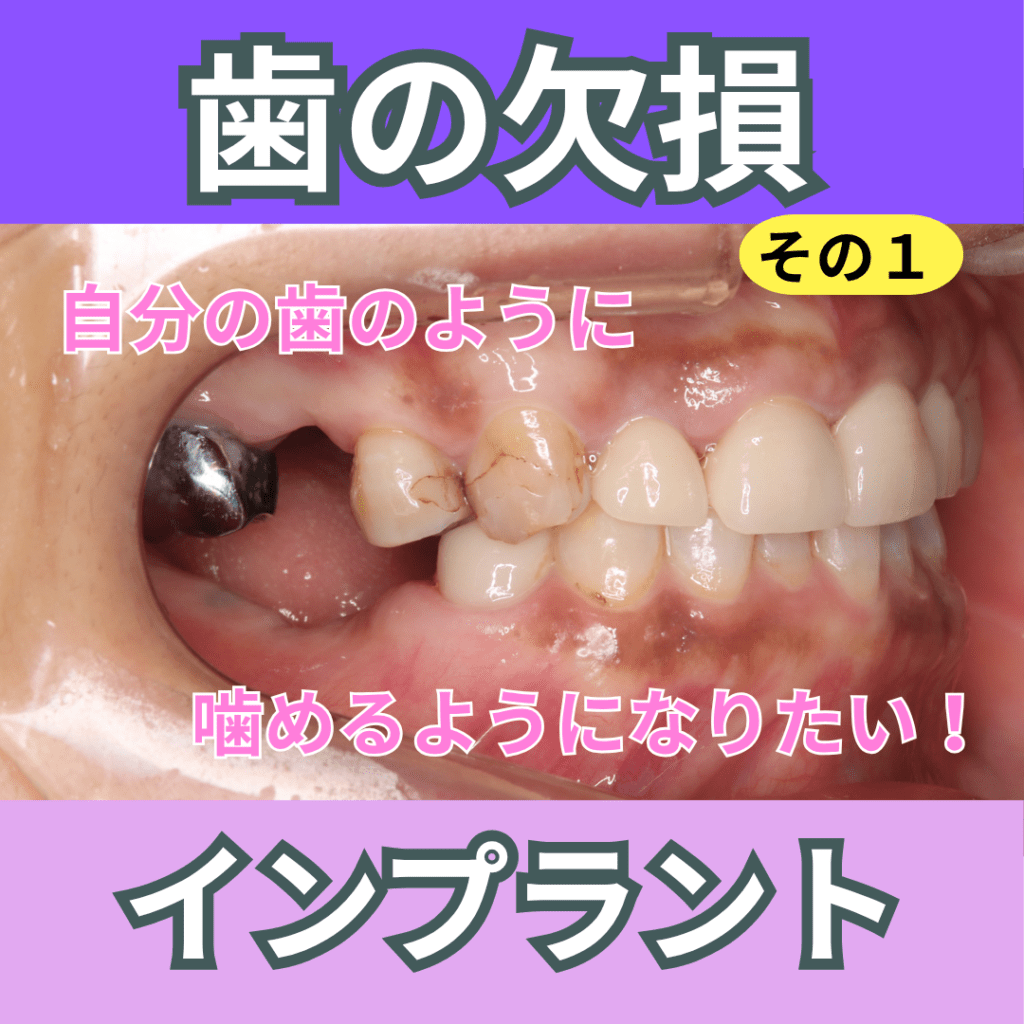 インプラント1