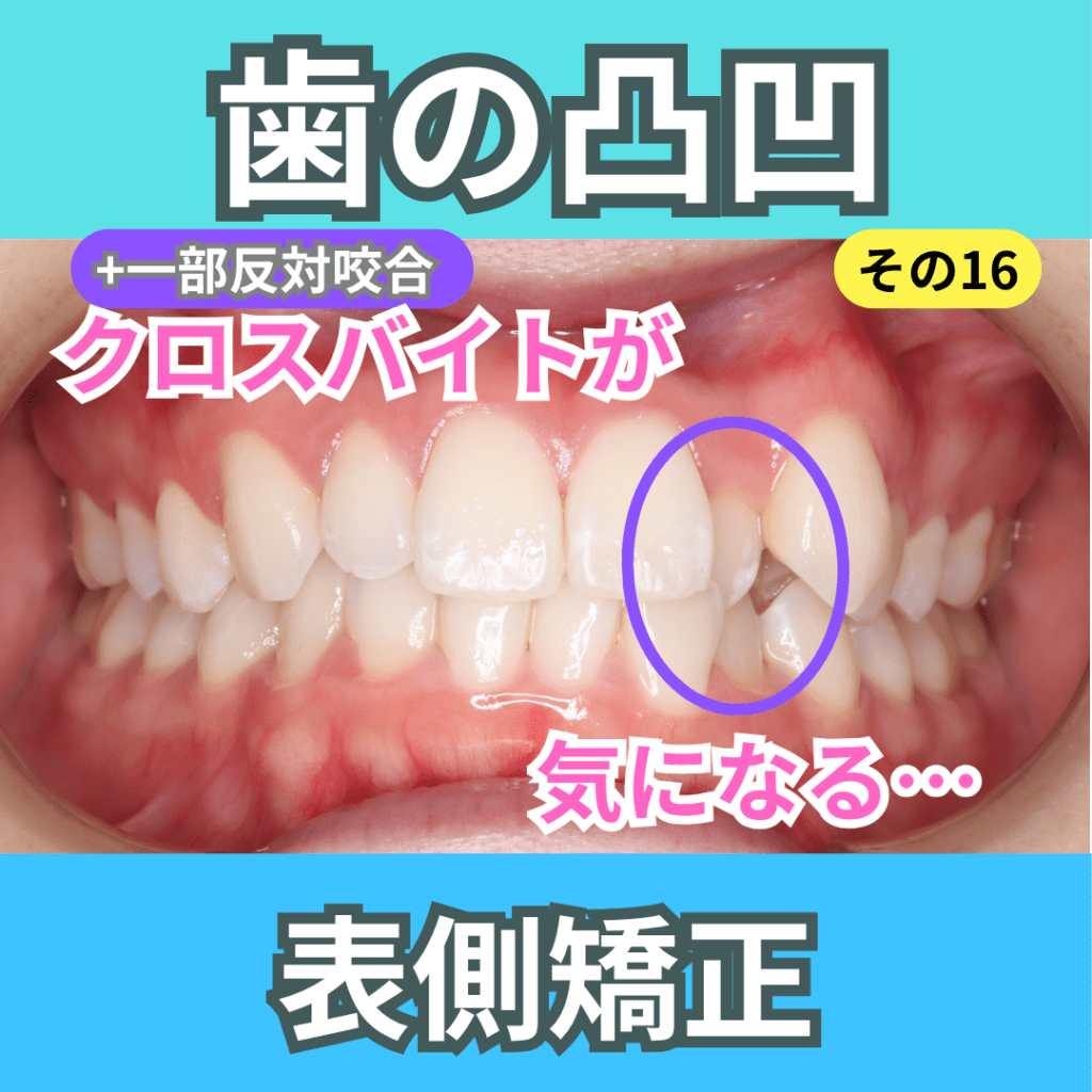 叢生16（表側矯正）