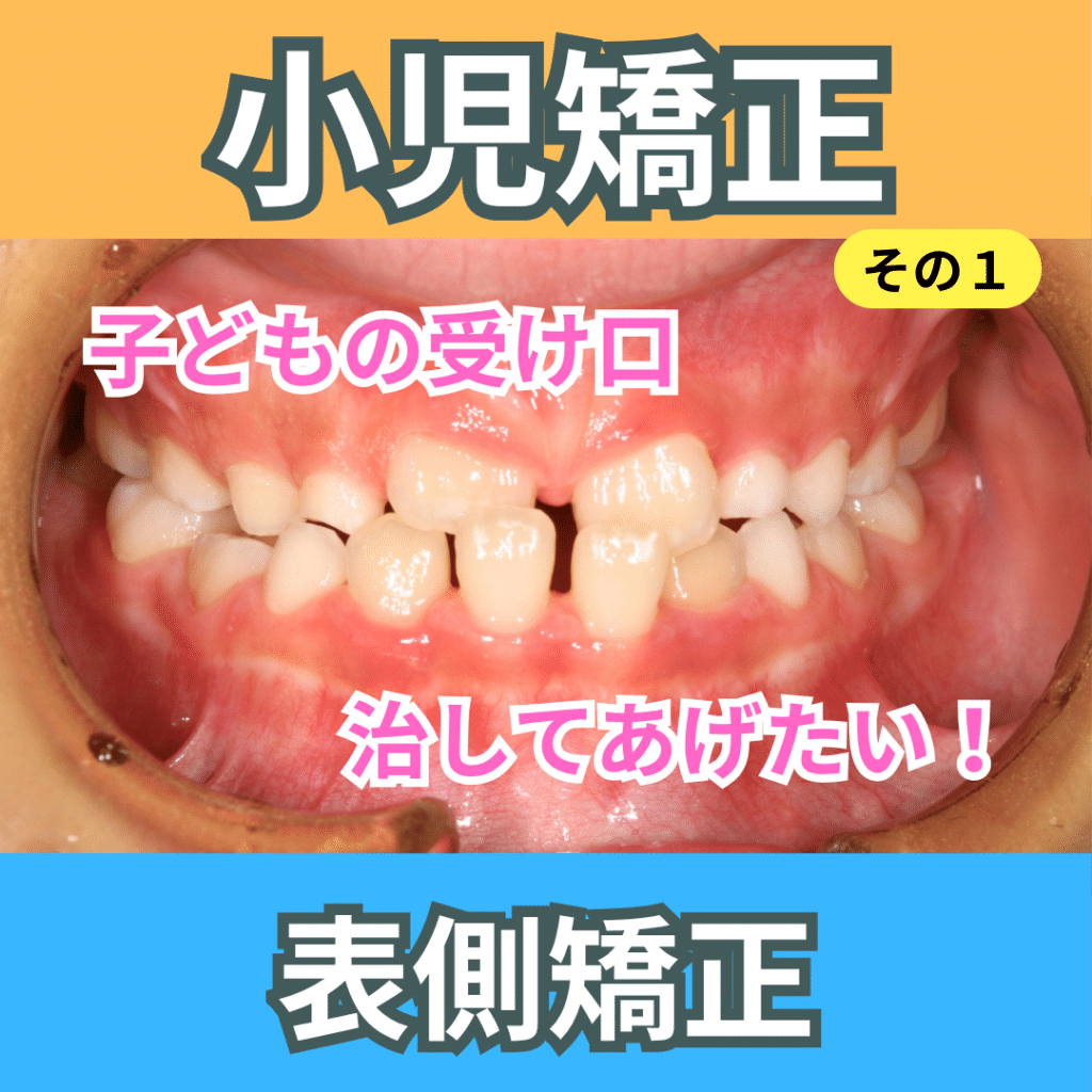 小児矯正（受け口）